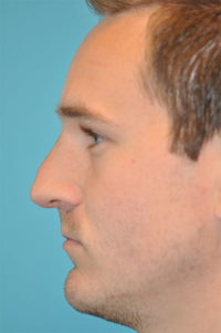 Revision Rhinoplasty Before and After Photos