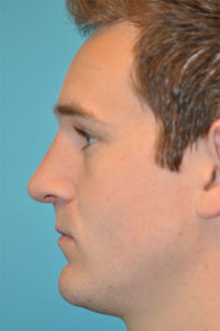 Revision Rhinoplasty Before and After Photos