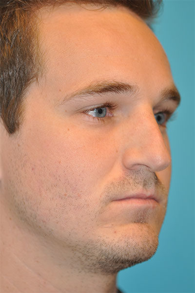 Revision Rhinoplasty Before and After Photos Case 5402 Before Photo Revision Rhinoplasty Before and After Photos