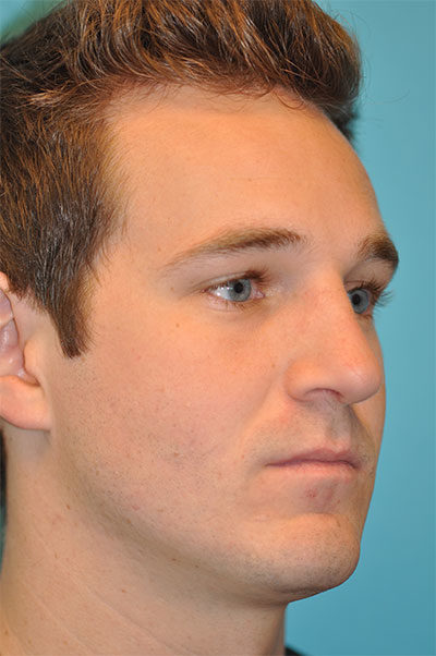 Revision Rhinoplasty Before and After Photos Case 5402 After Photo Revision Rhinoplasty Before and After Photos