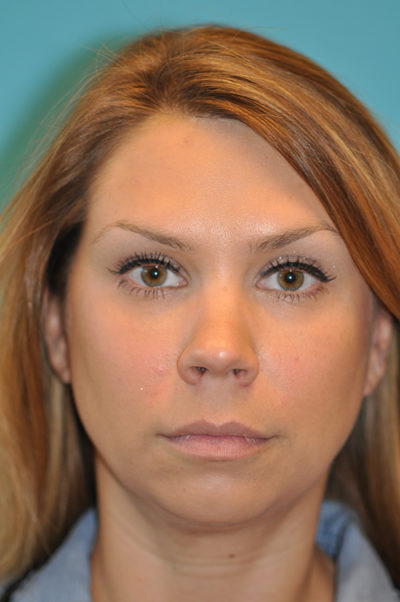 Rhinoplasty (Nose Job) Before and After Photos Case 5412 Before Photo Rhinoplasty (Nose Job) Before and After Photos
