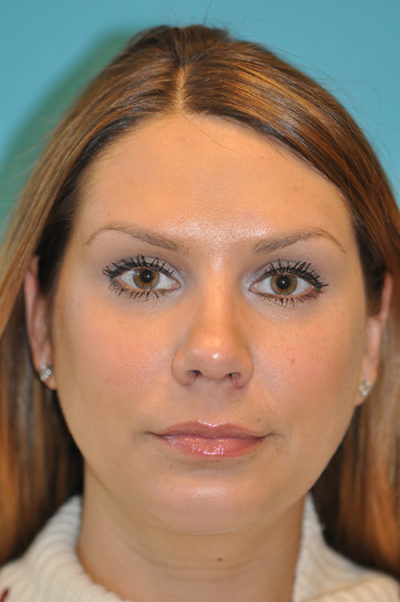 Rhinoplasty (Nose Job) Before and After Photos Case 5412 After Photo Rhinoplasty (Nose Job) Before and After Photos