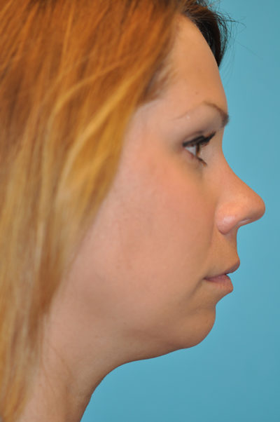 Rhinoplasty (Nose Job)