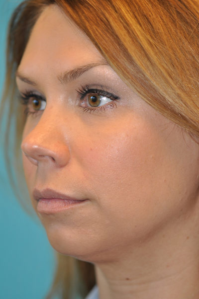 Rhinoplasty (Nose Job) Before and After Photos Case 5412 Before Photo Rhinoplasty (Nose Job) Before and After Photos