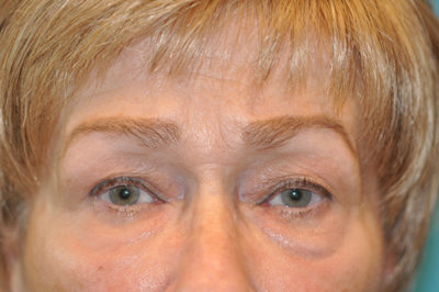 Upper Blepharoplasty (Eyelid) Before and After Photos