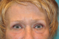 Upper Blepharoplasty (Eyelid) Before and After Photos