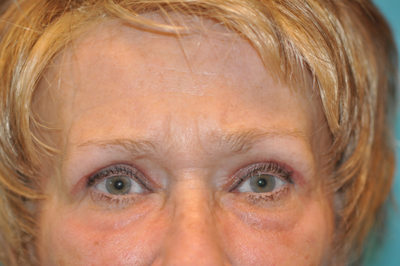 Upper Blepharoplasty (Eyelid) Before and After Photos Case 5440 After Photo Upper Blepharoplasty (Eyelid) Before and After Photos