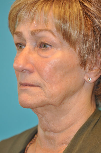 Upper Blepharoplasty (Eyelid) Before and After Photos Case 5440 Before Photo Upper Blepharoplasty (Eyelid) Before and After Photos