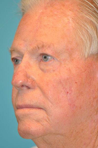 Skin Cancer Reconstruction Before and After Photos Case 5438 After Photo Skin Cancer Reconstruction Before and After Photos