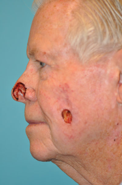 Skin Cancer Reconstruction Before and After Photos