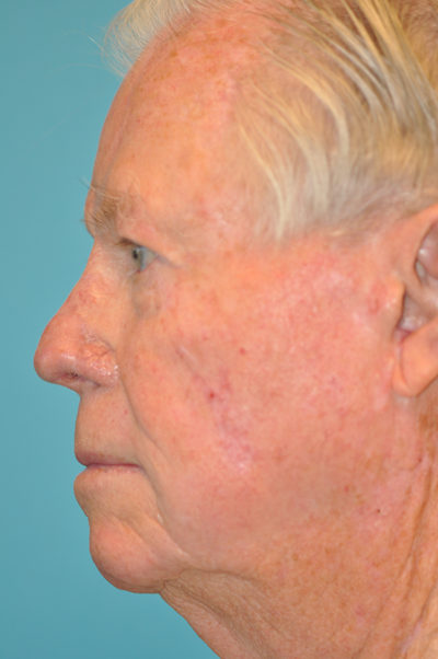 Skin Cancer Reconstruction Before and After Photos Case 5438 After Photo Skin Cancer Reconstruction Before and After Photos