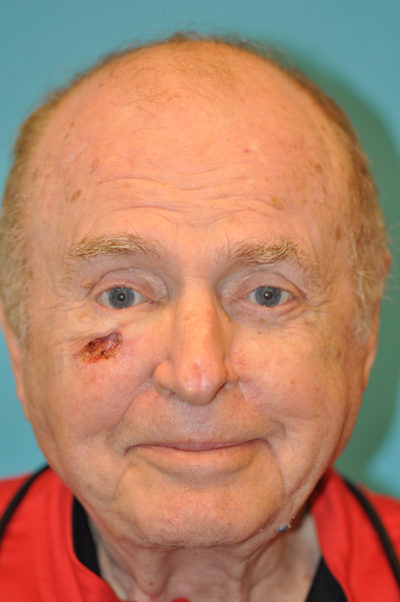 Skin Cancer Reconstruction Before and After Photos Case 5439 Before Photo Skin Cancer Reconstruction Before and After Photos