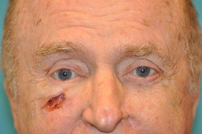 Skin Cancer Reconstruction Before and After Photos Case 5439 Before Photo Skin Cancer Reconstruction Before and After Photos