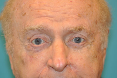 Skin Cancer Reconstruction Before and After Photos Case 5439 After Photo Skin Cancer Reconstruction Before and After Photos