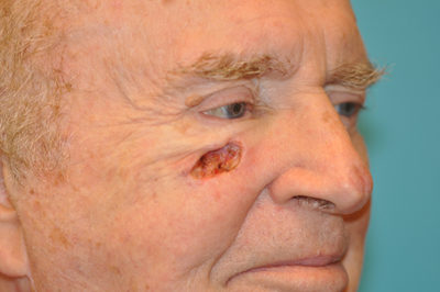 Skin Cancer Reconstruction Before and After Photos Case 5439 Before Photo Skin Cancer Reconstruction Before and After Photos