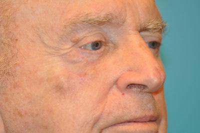 Skin Cancer Reconstruction Before and After Photos Case 5439 After Photo Skin Cancer Reconstruction Before and After Photos
