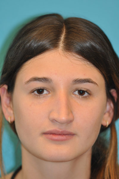 Rhinoplasty (Nose Job) Before and After Photos Case 5479 Before Photo Rhinoplasty (Nose Job) Before and After Photos