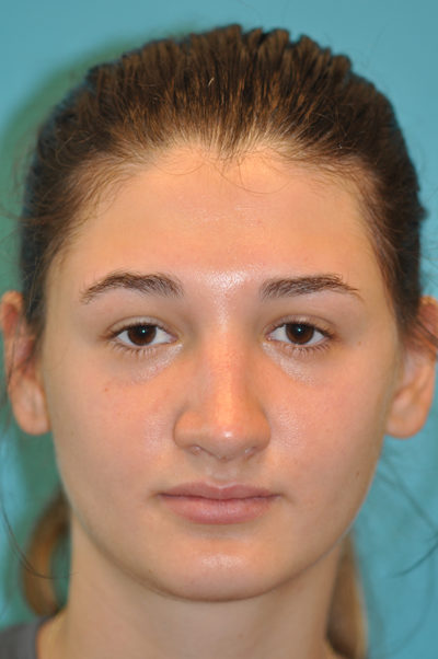 Rhinoplasty (Nose Job) Before and After Photos Case 5479 After Photo Rhinoplasty (Nose Job) Before and After Photos