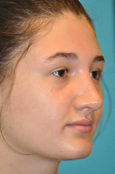 Rhinoplasty (Nose Job) Before and After Photos Case 5479 After Photo Rhinoplasty (Nose Job) Before and After Photos