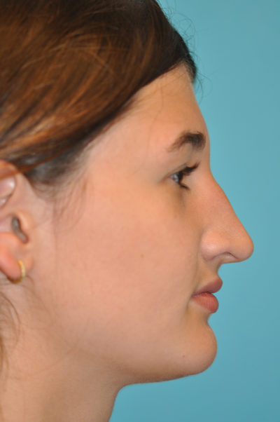 Rhinoplasty (Nose Job) Before and After Photos