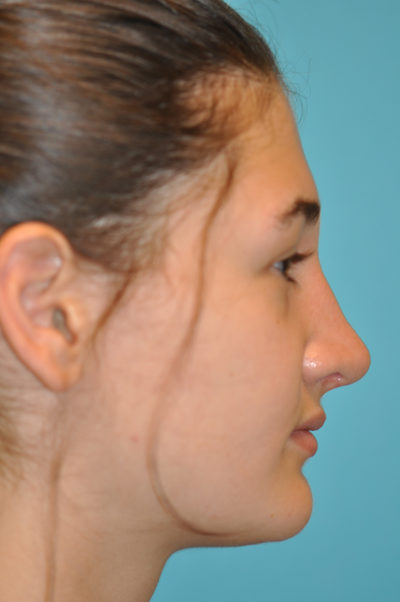 Rhinoplasty (Nose Job) Before and After Photos Case 5479 After Photo Rhinoplasty (Nose Job) Before and After Photos