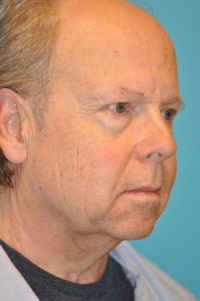 Lower Blepharoplasty (Eyelid) Before and After Photos