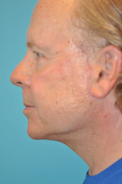 Lower Blepharoplasty (Eyelid) Before and After Photos Case 5489 After Photo Lower Blepharoplasty (Eyelid) Before and After Photos
