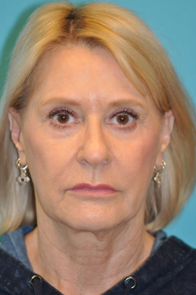 Rhytidectomy (Facelift)