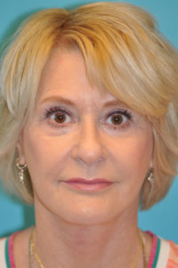 Facelift and Necklift Before and After Photos