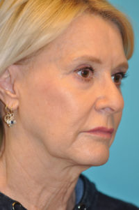 Facelift and Necklift Before and After Photos
