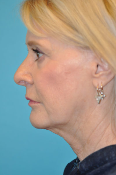Rhytidectomy (Facelift)