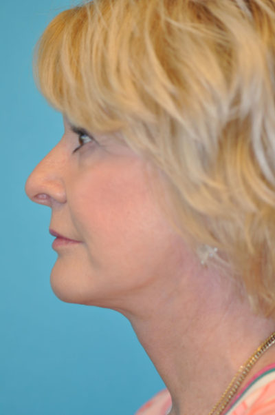 Rhytidectomy (Facelift)