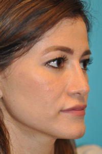 Revision Rhinoplasty Before and After Photos
