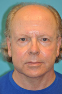Facelift and Necklift Before and After Photos