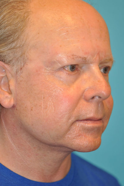 Facelift and Necklift Before and After Photos