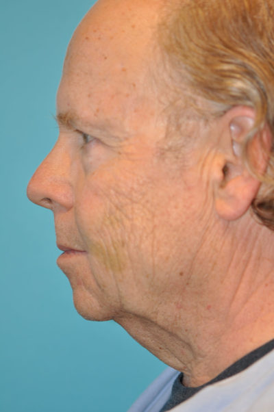 Facelift and Necklift Before and After Photos
