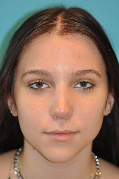 Rhinoplasty (Nose Job) Before and After Photos Case 5554 After Photo Rhinoplasty (Nose Job) Before and After Photos