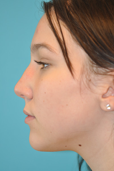 Rhinoplasty (Nose Job) Before and After Photos Case 5554 Before Photo Rhinoplasty (Nose Job) Before and After Photos