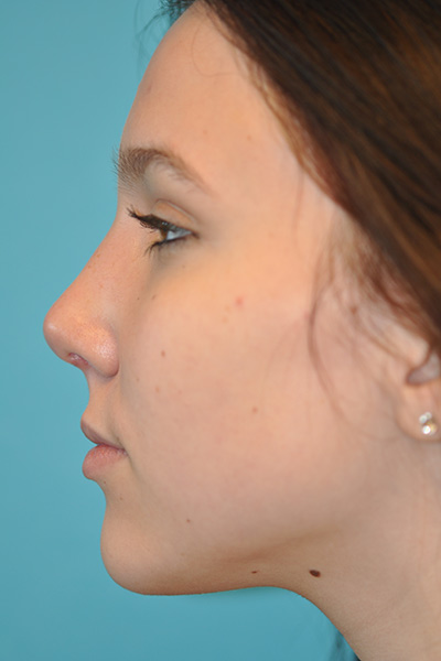 Rhinoplasty (Nose Job) Before and After Photos Case 5554 After Photo Rhinoplasty (Nose Job) Before and After Photos