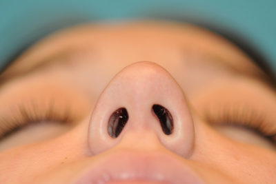 Rhinoplasty (Nose Job) Before and After Photos Case 5554 Before Photo Rhinoplasty (Nose Job) Before and After Photos