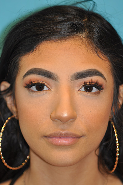 Rhinoplasty (Nose Job) Before and After Photos Case 5564 Before Photo Rhinoplasty (Nose Job) Before and After Photos