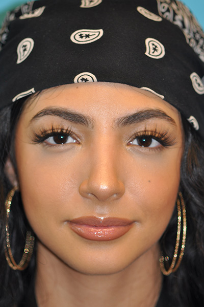 Rhinoplasty (Nose Job) Before and After Photos Case 5564 After Photo Rhinoplasty (Nose Job) Before and After Photos