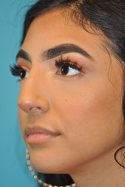 Rhinoplasty (Nose Job) Before and After Photos Case 5564 Before Photo Rhinoplasty (Nose Job) Before and After Photos