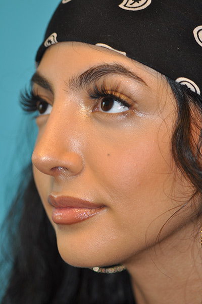 Rhinoplasty (Nose Job) Before and After Photos Case 5564 After Photo Rhinoplasty (Nose Job) Before and After Photos