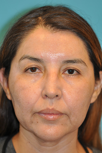 Rhinoplasty (Nose Job) Before and After Photos Case 5571 After Photo Rhinoplasty (Nose Job) Before and After Photos