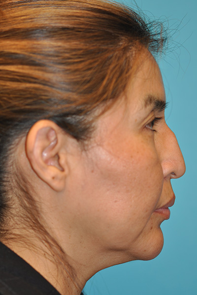 Rhinoplasty (Nose Job) Before and After Photos Case 5571 Before Photo Rhinoplasty (Nose Job) Before and After Photos
