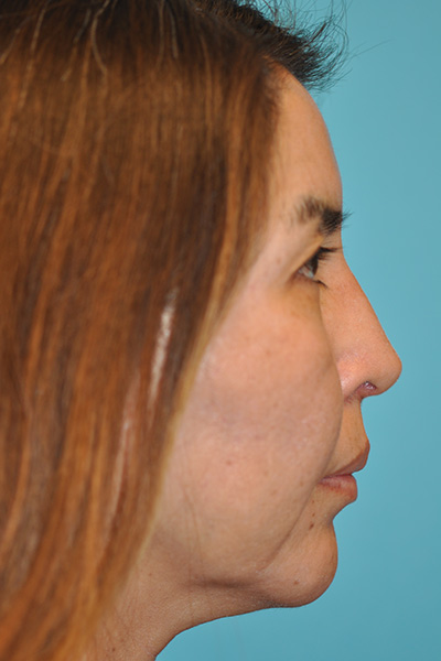Rhinoplasty (Nose Job) Before and After Photos Case 5571 After Photo Rhinoplasty (Nose Job) Before and After Photos