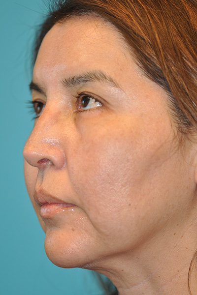 Rhinoplasty (Nose Job) Before and After Photos Case 5571 After Photo Rhinoplasty (Nose Job) Before and After Photos
