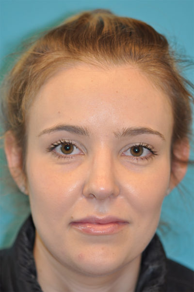 Rhinoplasty (Nose Job) Before and After Photos Case 5657 After Photo Rhinoplasty (Nose Job) Before and After Photos
