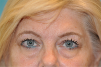 Upper Blepharoplasty (Eyelid) Before and After Photos
